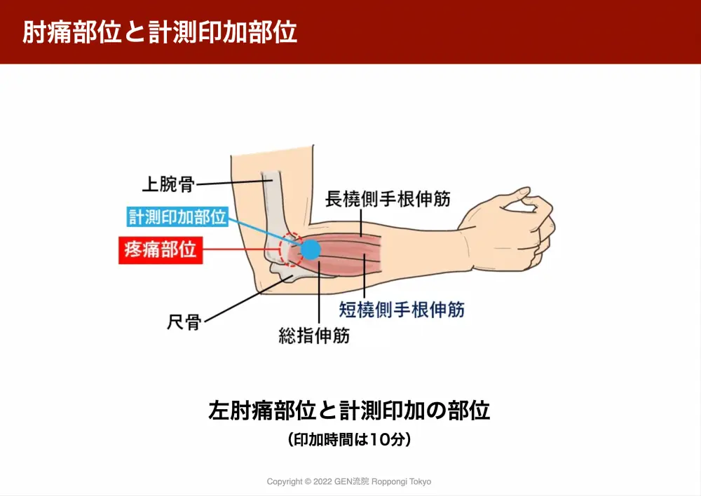 肘の疼痛部位