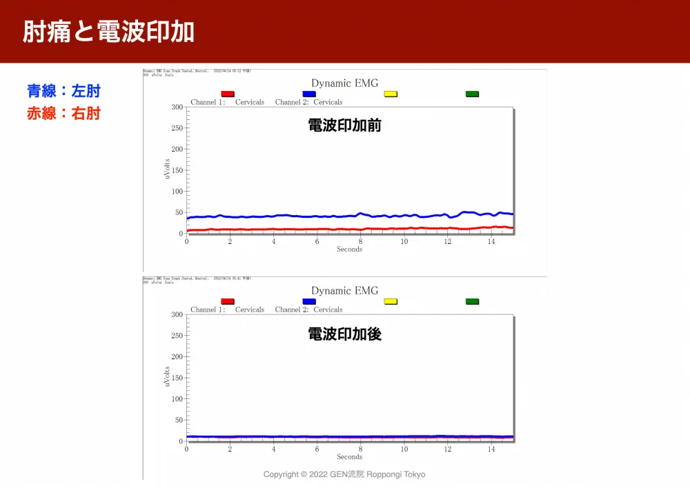 筋電計計測結果